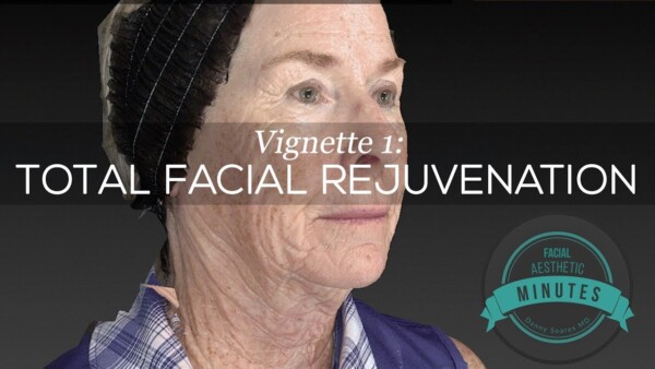 69 yo Female Total Facial Rejuvenation – An Amazing Transformation | Aesthetic Minutes #Facelift